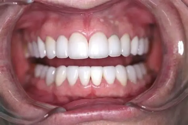 Full Mouth Rehabilitation