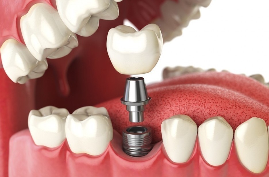 Dental Implant